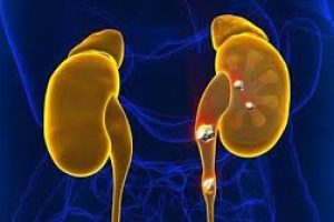 فيتامين يمكن أن يسبب تكون الحصى في الكلى