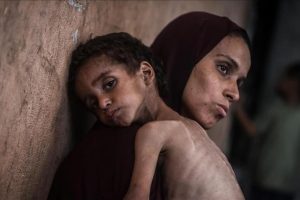 الأمم المتحدة: وفاة أكثر من 100 طفل في غزة بسبب سوء التغذية